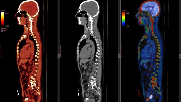 /CT-MRI-PET-比較
