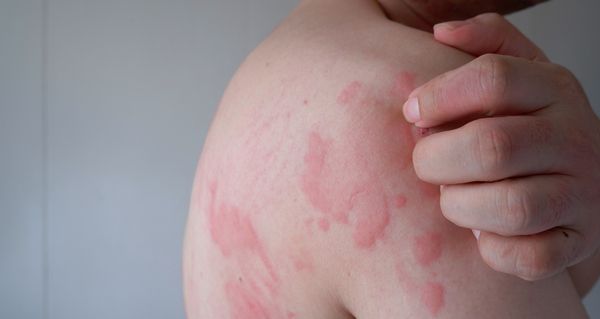 【風癩/蕁麻疹】會傳染嗎？了解成因、中西醫治療及急救方法