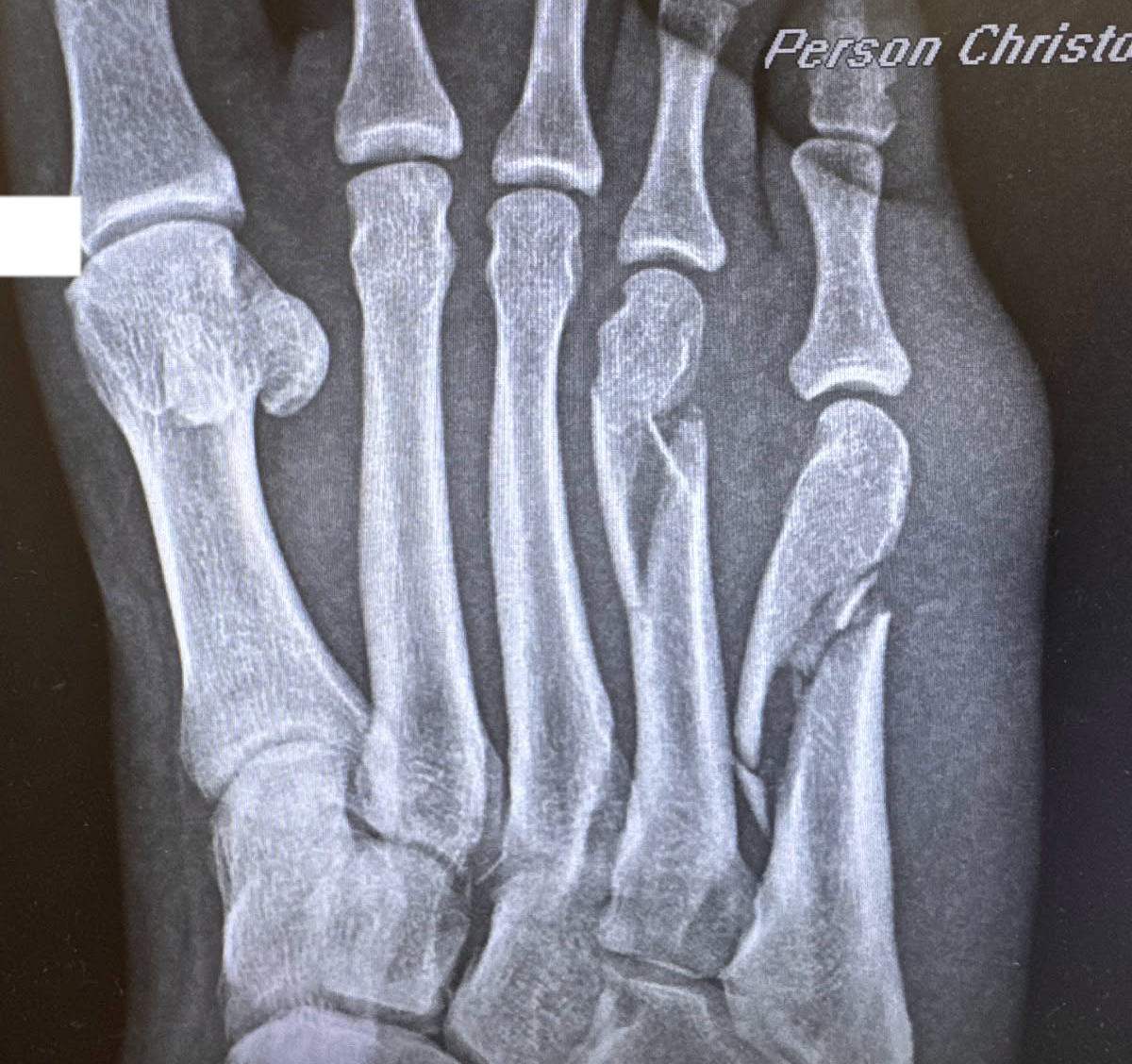 An X-Ray of my foot, the 4th and 5th metatarsal are in pieces.