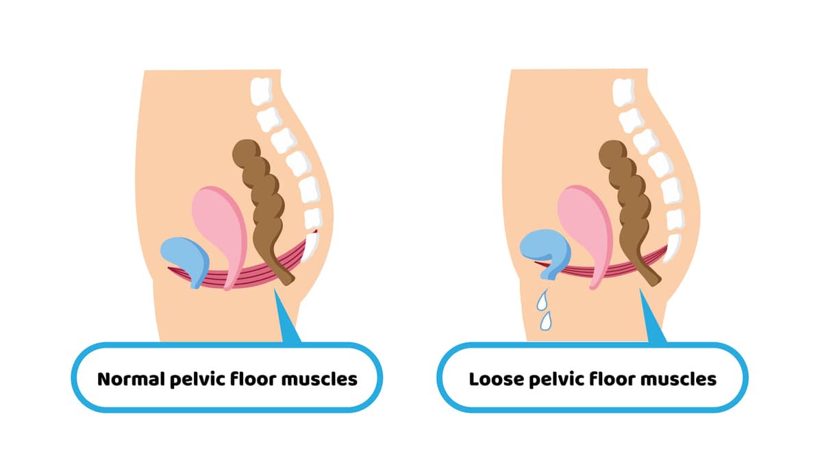 An illustration depicting normal and loose pelvic floor muscles