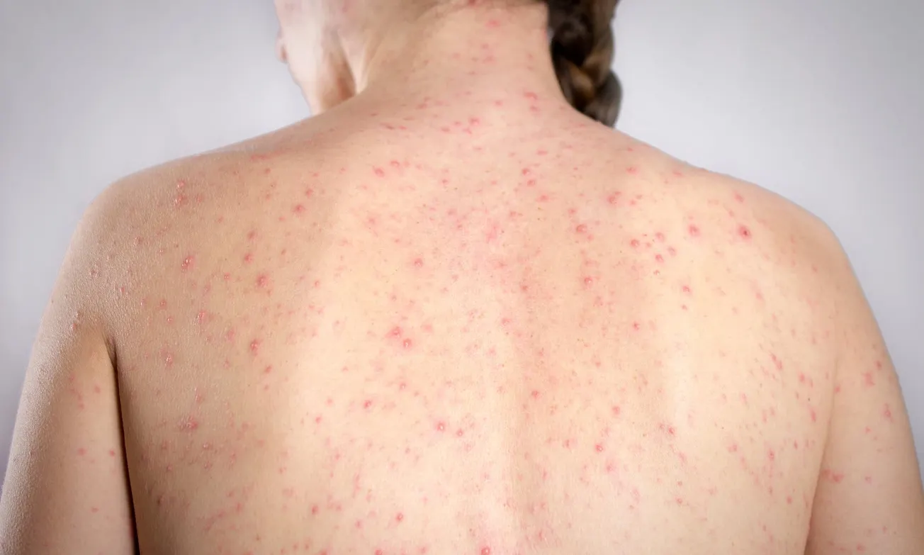 Bureaucrats Prevent Schools from Protecting Kids from Measles