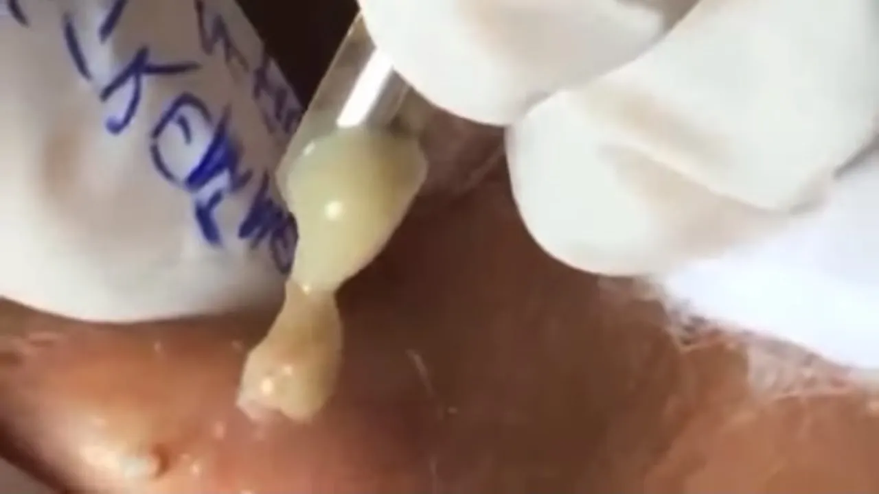 Cyst Saturday: Huge Pimple Popping With So Much Pus Blackhead & Acne Treatment 2019