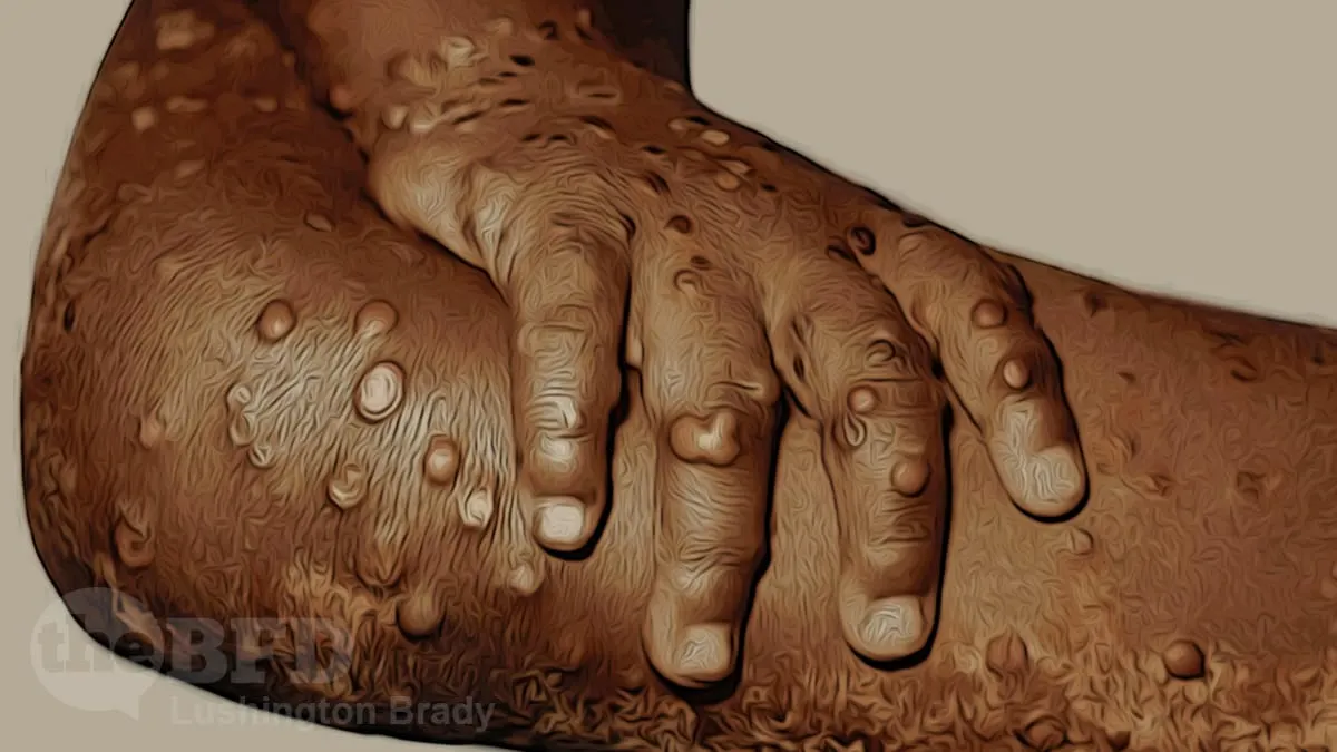 Monkeypox Mainly Affects Gay Men
