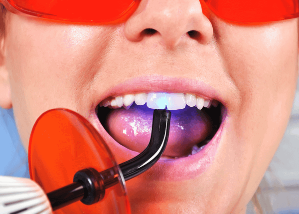 Dos and Don'ts After Tooth Filling