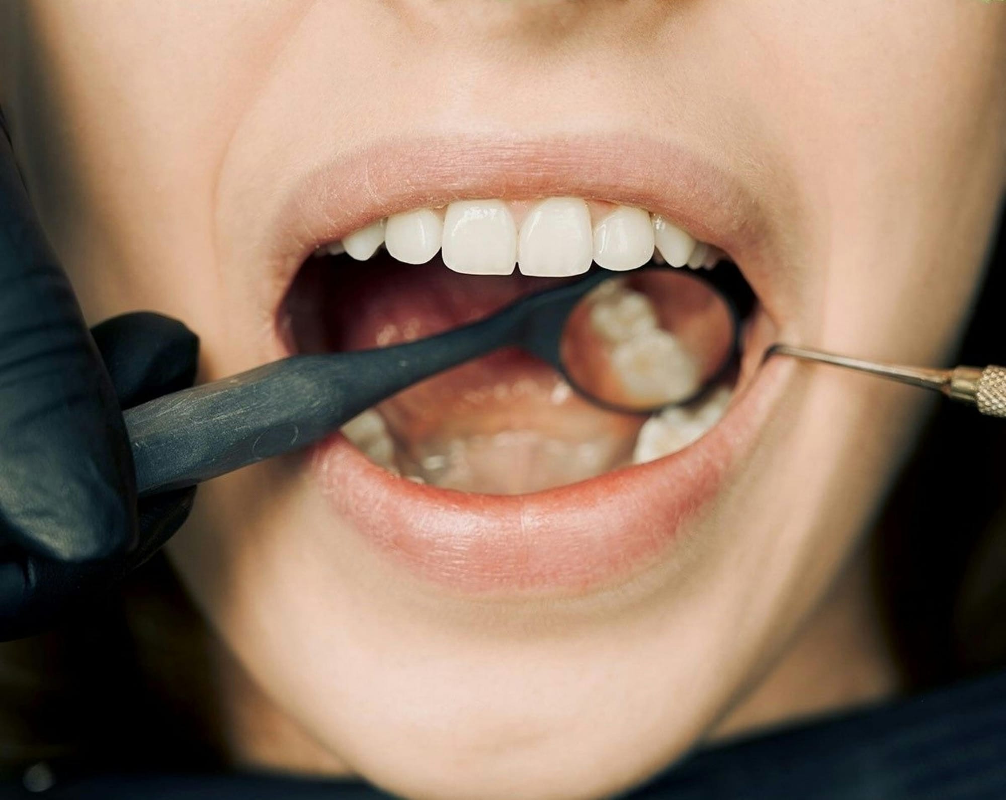 Gloved dental professional examines a patient’s teeth with a dental mirror in a clinic setting
