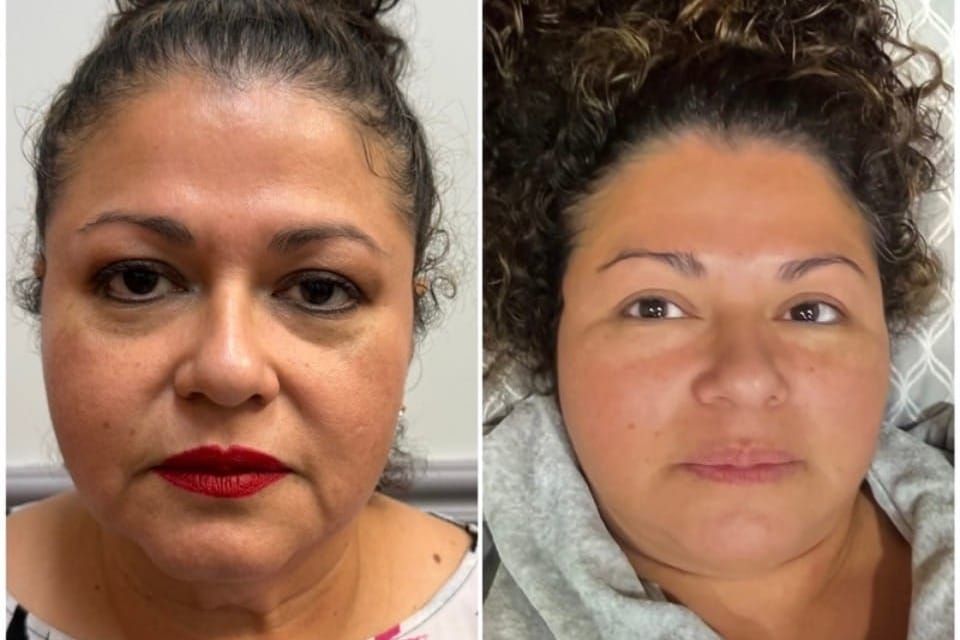 The Secret to Snatched Skin? Why Women Are Turning to PDO Threads for the Ultimate Non-Surgical Lift