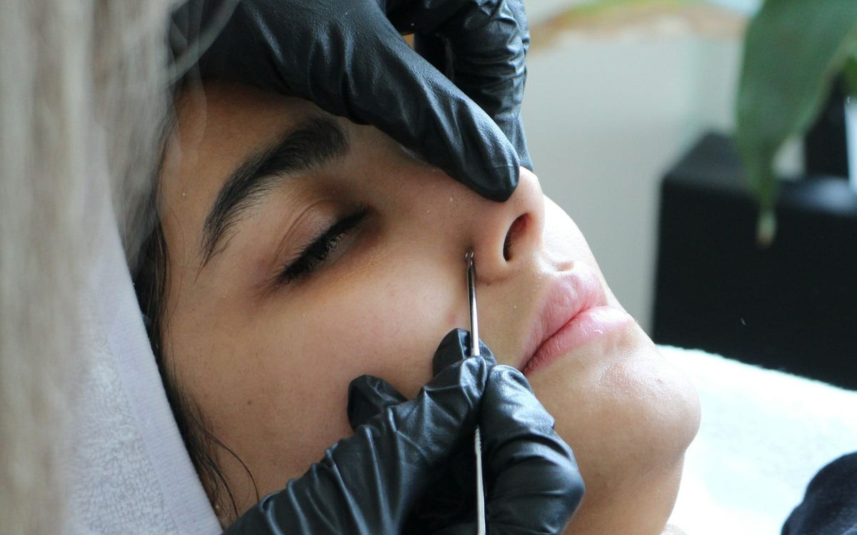 Should You Pop Pimples? Why Professional Extractions Are Safer