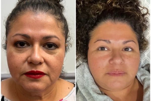 The Secret to Snatched Skin? Why Women Are Turning to PDO Threads for the Ultimate Non-Surgical Lift