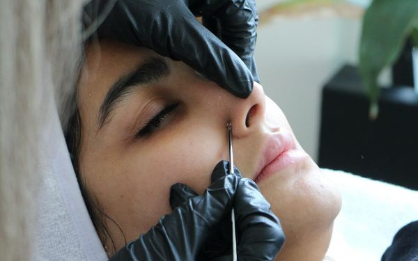 Should You Pop Pimples? Why Professional Extractions Are Safer