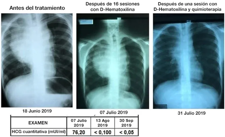  D-hematoxilina, vitamina C