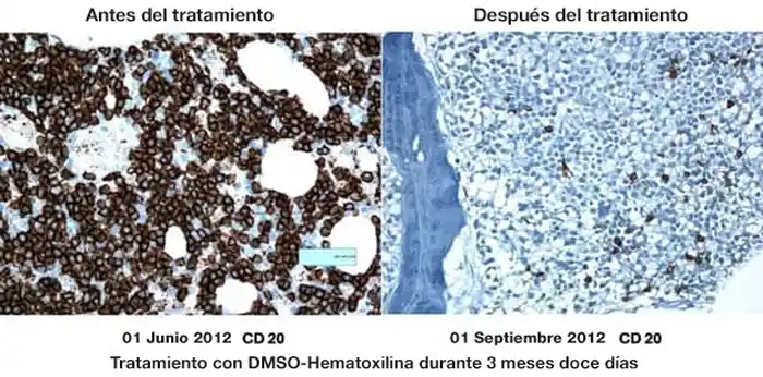 D-hematoxilina y EDTA