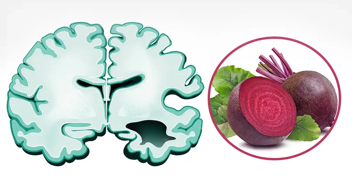 El betabel podría ayudar a prevenir la enfermedad de Alzheimer