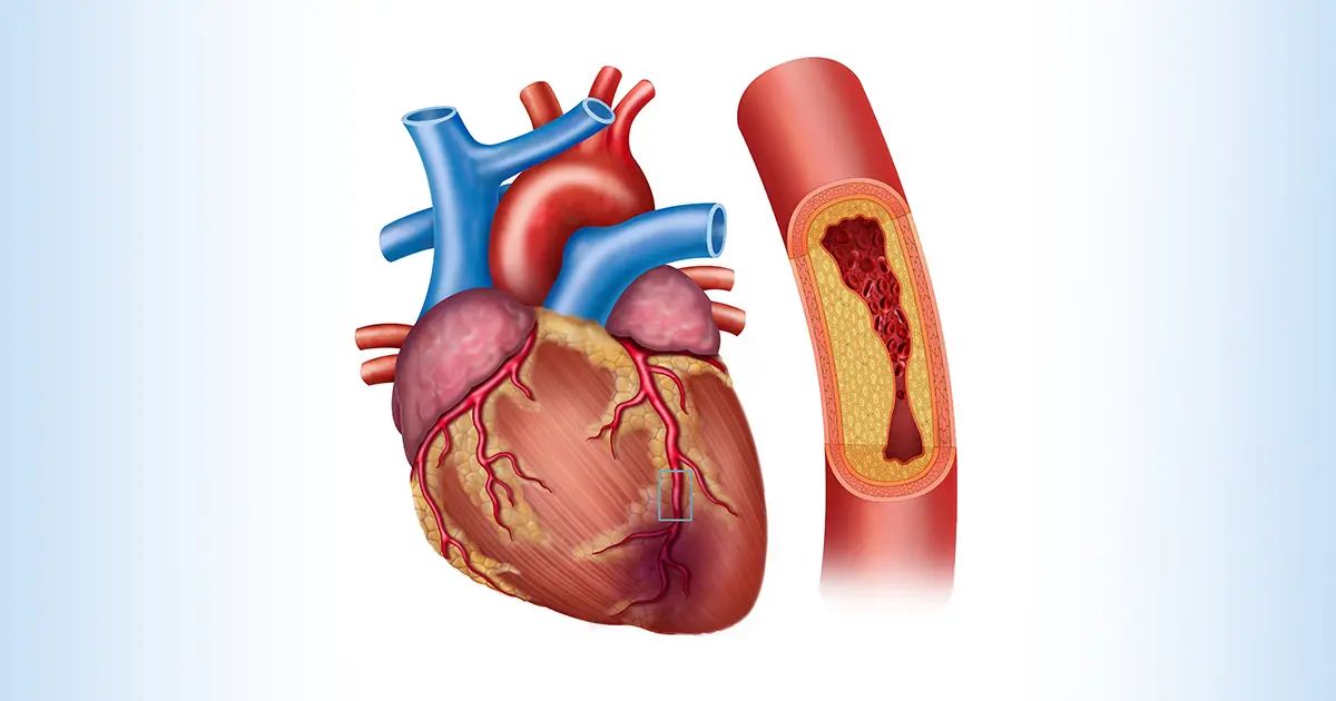 Las vitaminas que reducen el riesgo de enfermedad de las arterias coronarias
