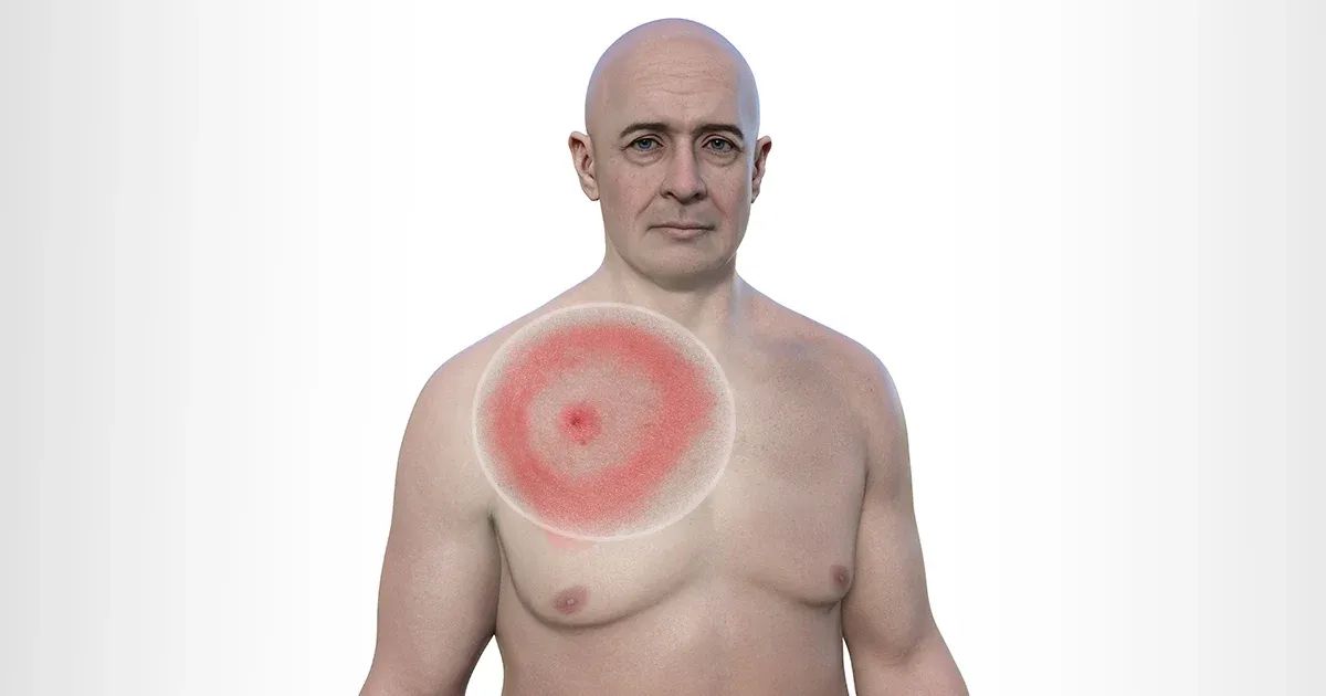 Actúe rápido si detecta este sarpullido en su piel: podría ser mortal