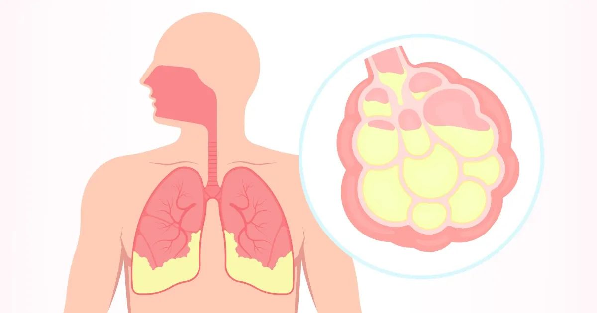 Los tratamientos naturales que ayudan en la lucha contra esta enfermedad incurable