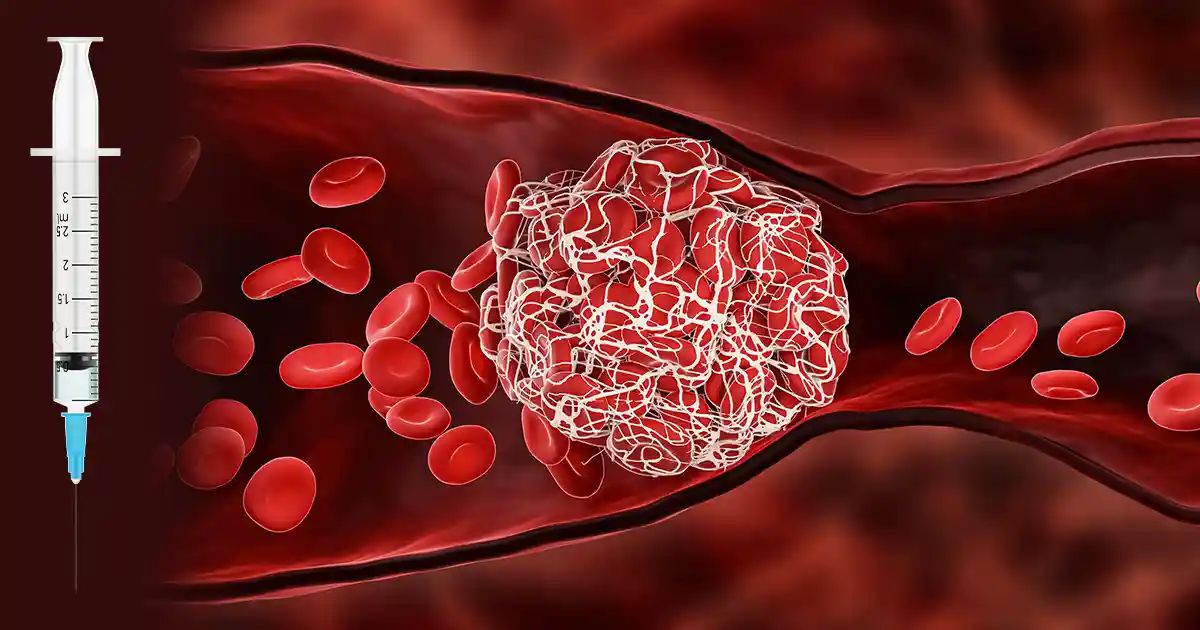 Estrategias para evitar los coágulos relacionados con las vacunas