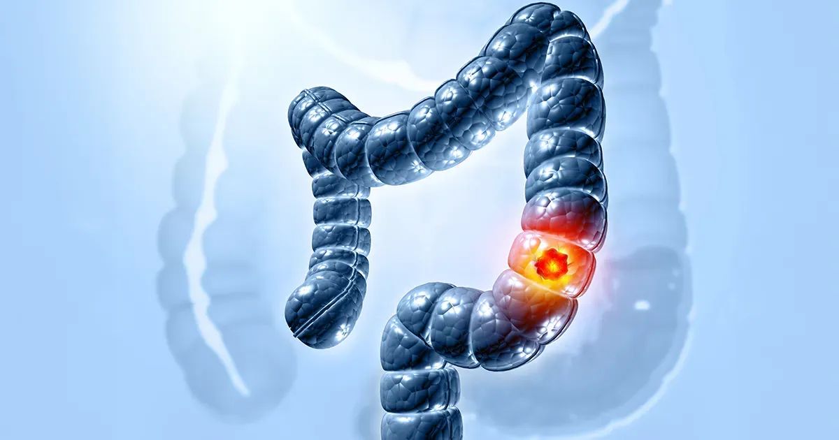 El escudo natural contra el cáncer de colon: estos alimentos son clave