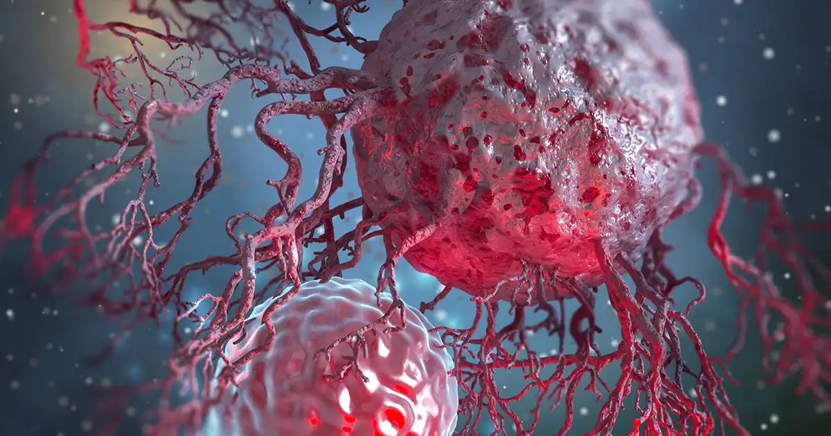 Estos son los factores que están impulsando el aumento de un cáncer peligroso