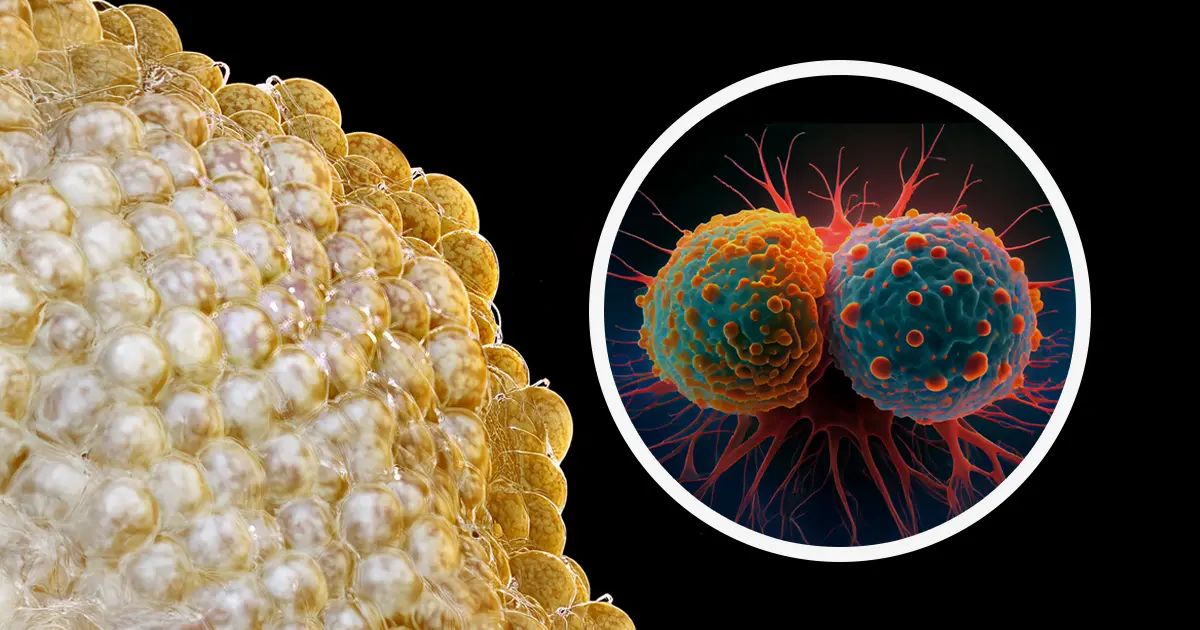Grasa letal: el ingrediente cotidiano que ayuda al cáncer a avanzar sin obstáculos
