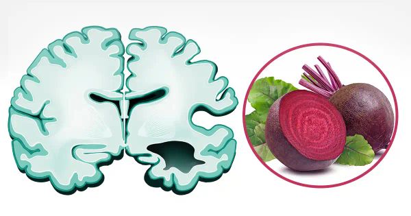 El betabel podría ayudar a prevenir la enfermedad de Alzheimer