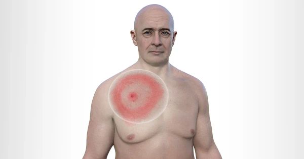 Actúe rápido si detecta este sarpullido en su piel: podría ser mortal