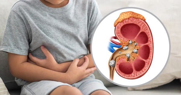 Los cálculos renales en los niños son cada vez más frecuentes: descubra por qué y cómo combatirlos