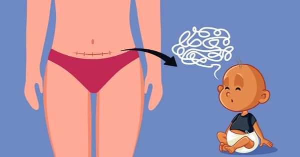 Las cesáreas podrían aumentar el riesgo de este trastorno mental en niños