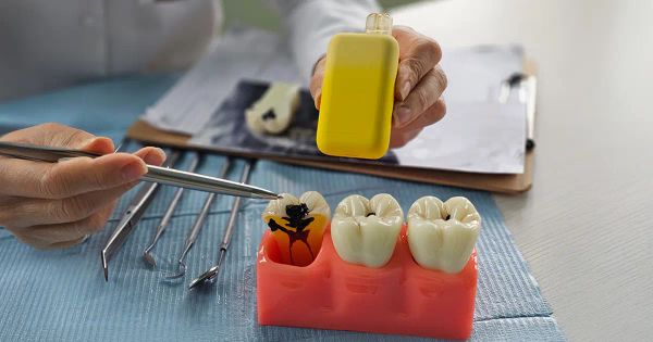 ¡Cuidado! Una tendencia popular está dañando su sonrisa