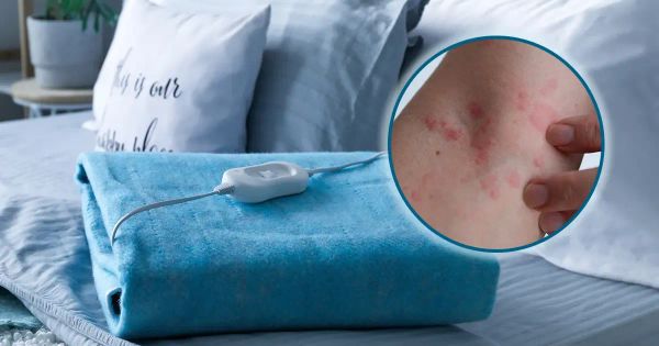 Cuidado: este calor "inofensivo" le está quemando la piel