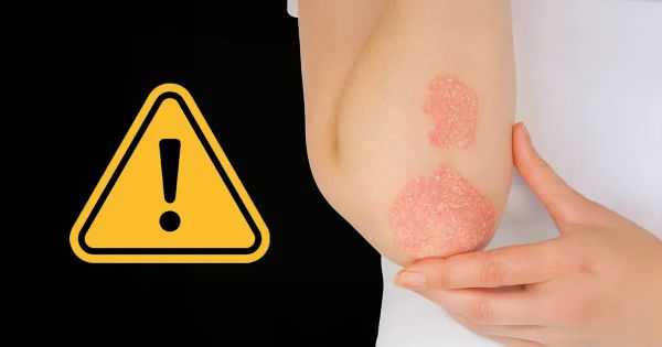 Los alimentos que aumentan su riesgo de sufrir problemas de la piel y que empeoran la inflamación