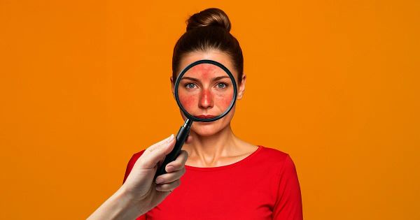 El círculo inflamatorio que está empeorando este problema cutáneo con el tiempo