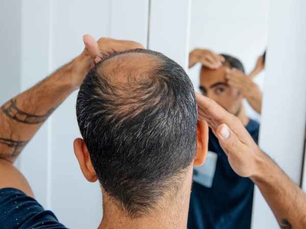Finasteride Side Effects And How To Manage Them