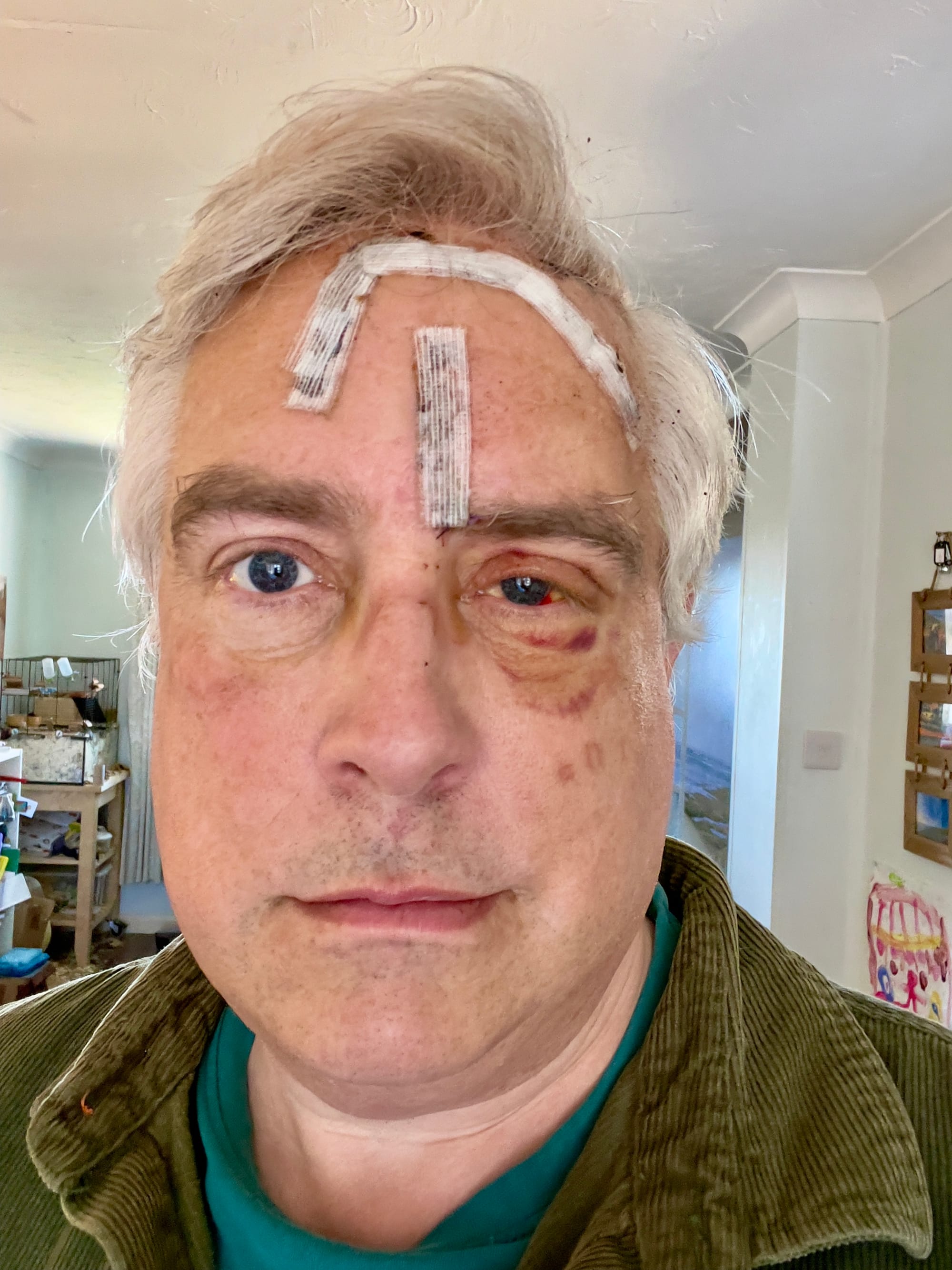 Adam Tinworth, one week after his facial trauma