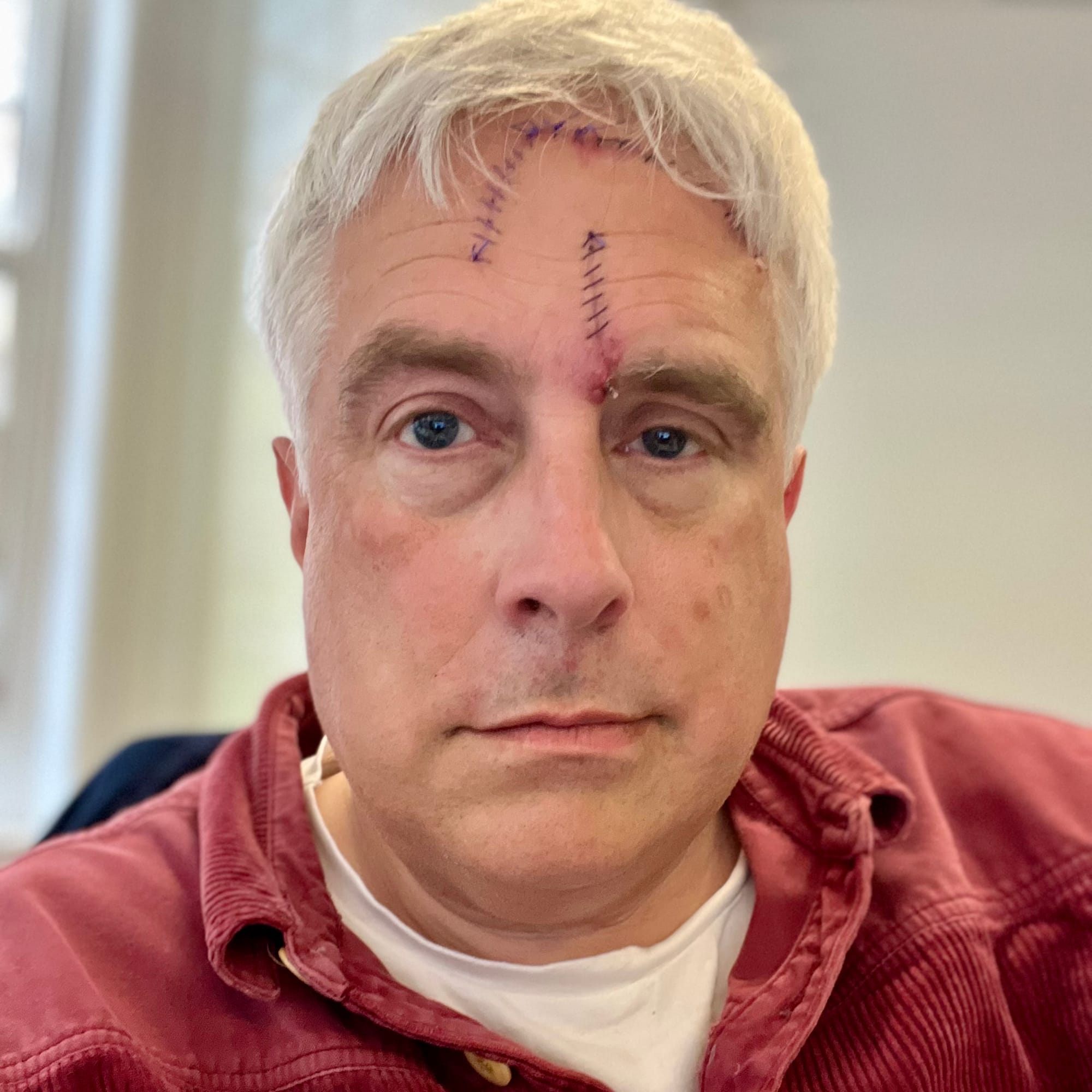Close-up portrait of a man with short grey hair and stitches running across his forehead after an injury, looking directly at the camera indoors.