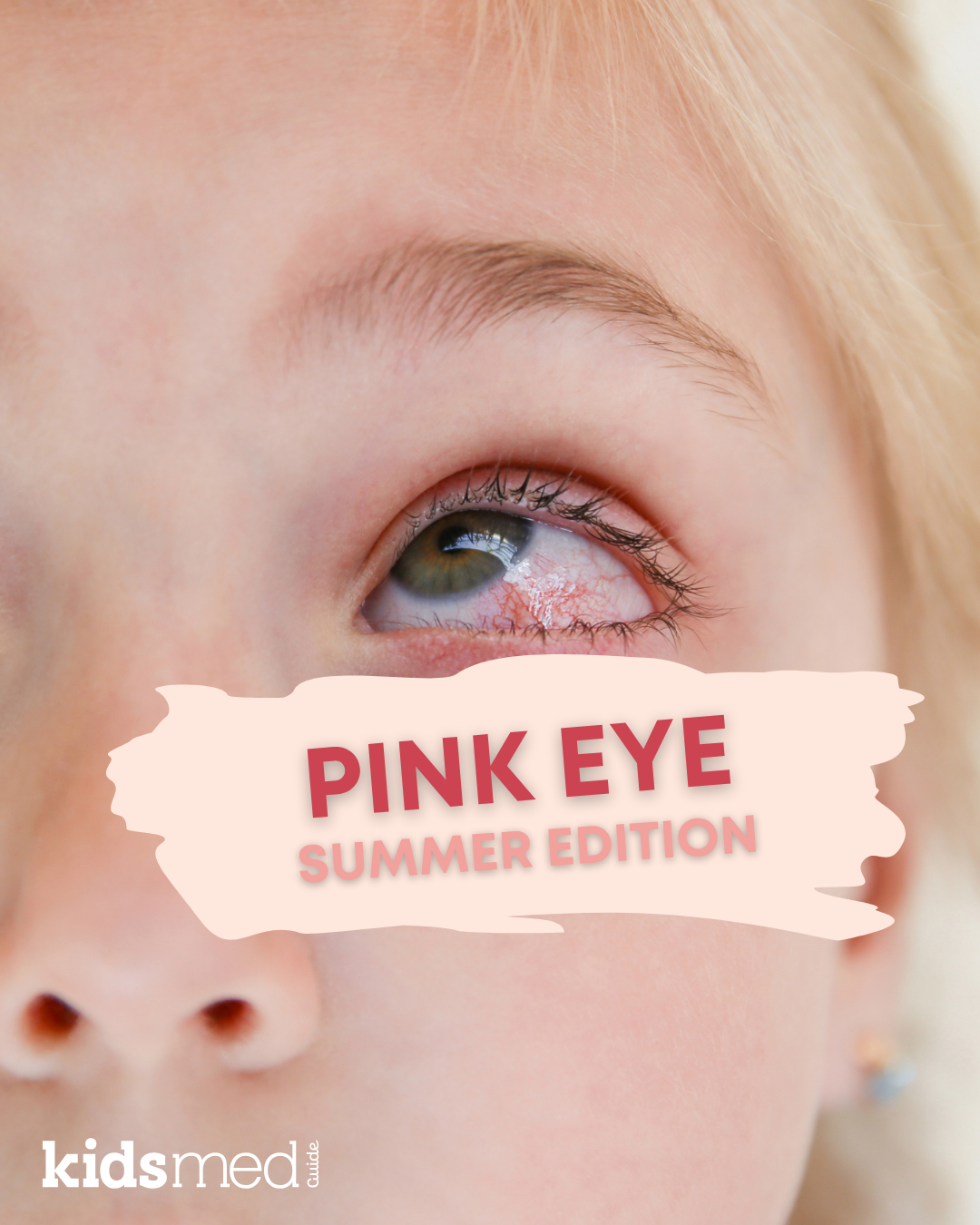 Pink Eye Treatments: What Actually Works