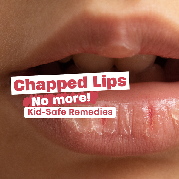 Chapped Lips: No More! Kid Safe Remedies