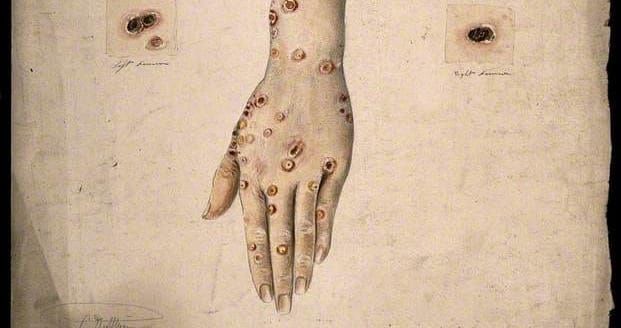 Syphilis came from the Americas