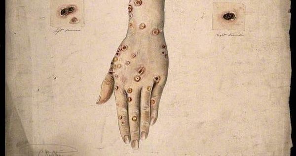 Syphilis came from the Americas