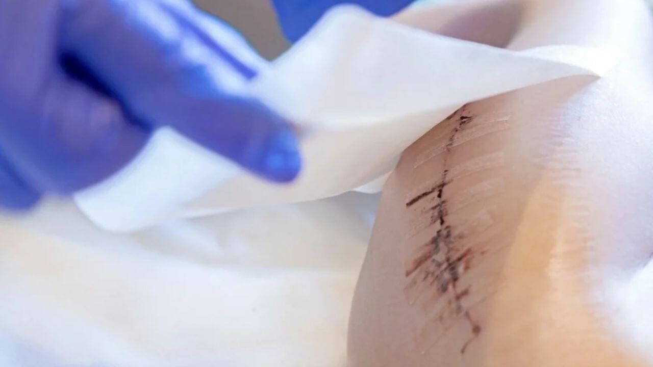 Doctor applying a silicone scar sheet to a patient's scar