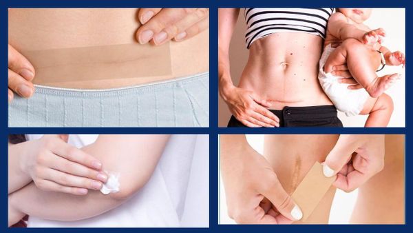 Discover the Best Scar Treatment for Fast Healing: Tape vs. Gel Showdown!