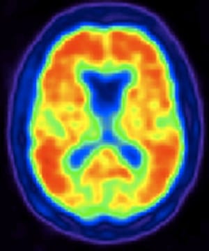 Positron Emission Tomography (PET) scans use radioactive tracers (radiopharmaceuticals) to assess bodily functions and to diagnose and treat disease. “In highly specialized research centers for Alzheimer’s disease,” Healey says, “researchers have used the combination of beta-amyloid on the PET scan and blood or CSF [cerebrospinal fluid] biomarkers to diagnose Alzheimer’s disease.”