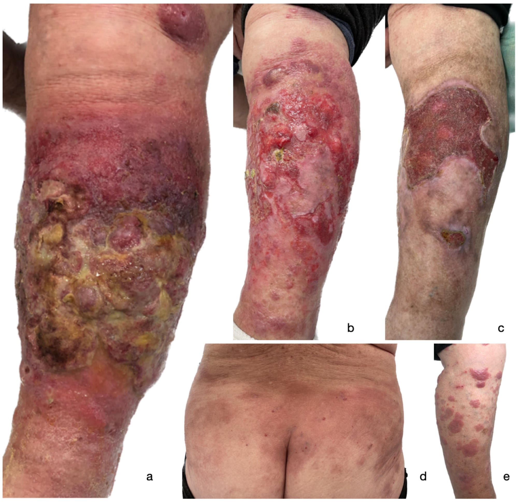 Figure 1. A clinical presentation of a widespread ulcerated tumor on the left lower extremity of the patient following 2nd dose of BNT162b2 COVID-19 mRNA vaccine (a); gradual improvement of the lesion following one month of treatment (b); partially healed ulcer five months following initial presentation (c). Patches and plaques on the trunk (d) and right lower extremity (e) that occurred after 1st dose of BNT162b2 COVID-19 mRNA vaccine.