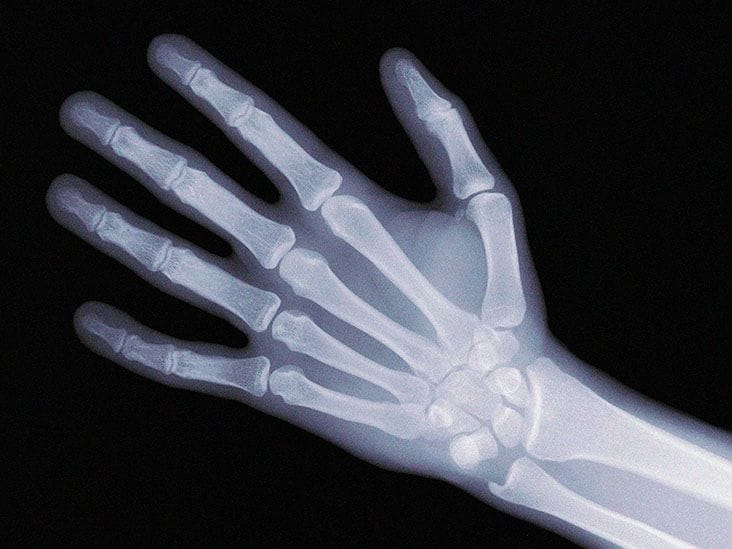 x-ray of healthy bones