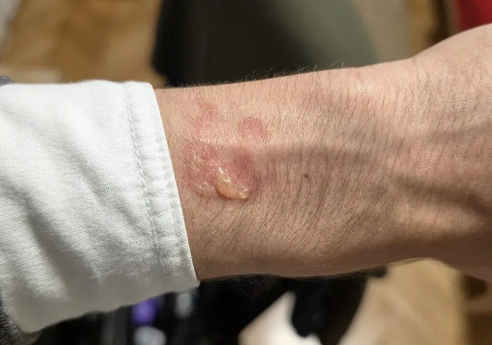 近日有部分 Samsung Galaxy Watch 用戶喺網上分享,指戴住隻錶之後,手腕感應器接觸嘅位置出現咗圓形嘅紅斑,甚至有用戶形容好似被燒傷一樣。