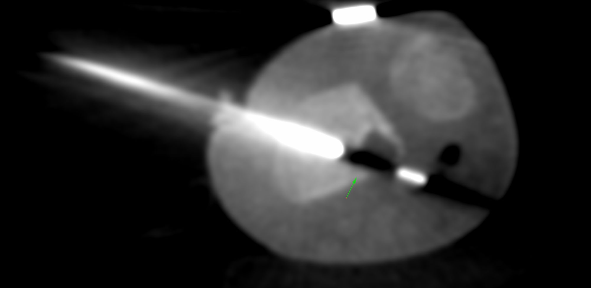 Case 9: Pediatric Distal Radius Lesion Biopsy
