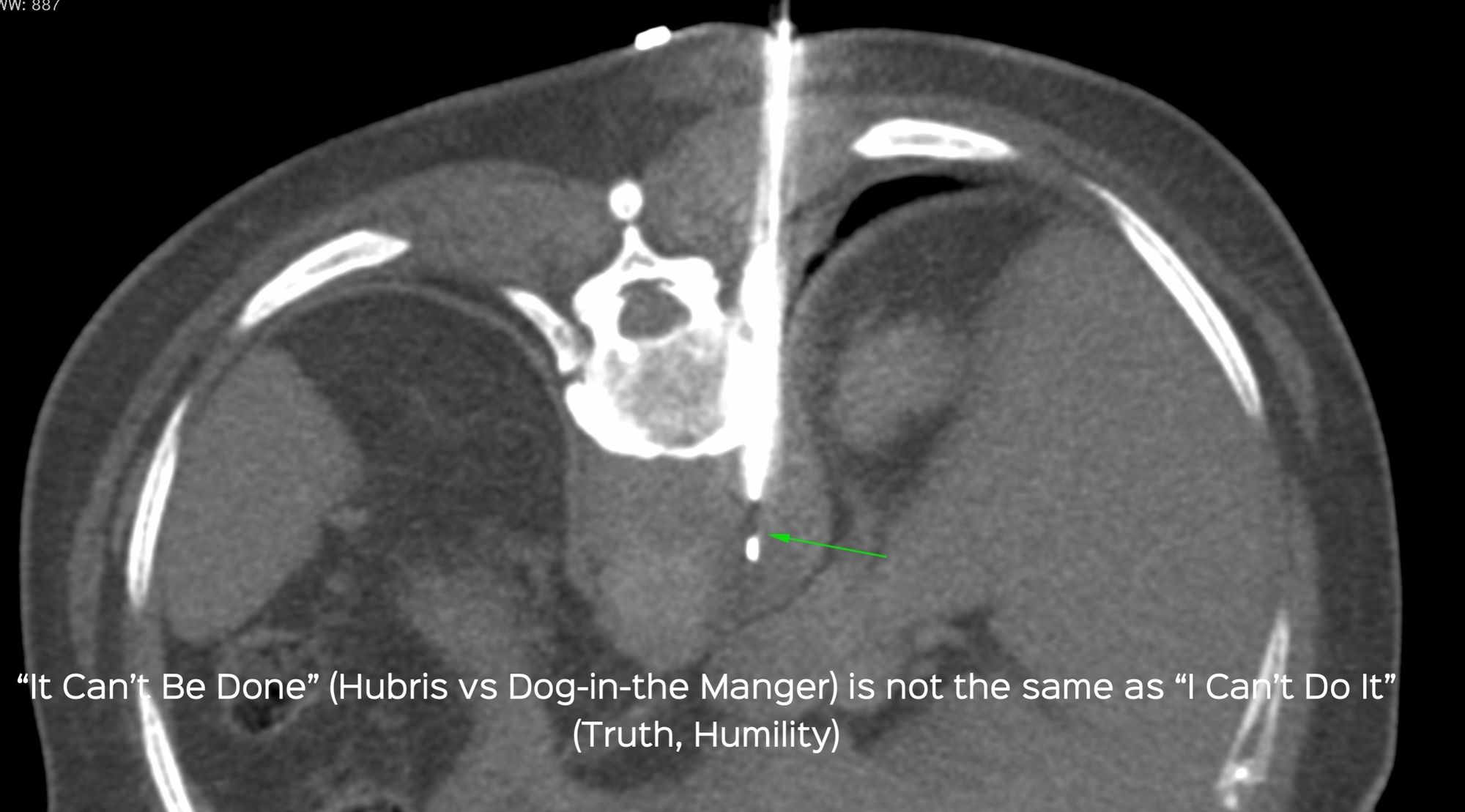Case 33: Retrocrural Mass Biopsy - The Difference Between "It Can't Be Done" and "I Can't Do It"
