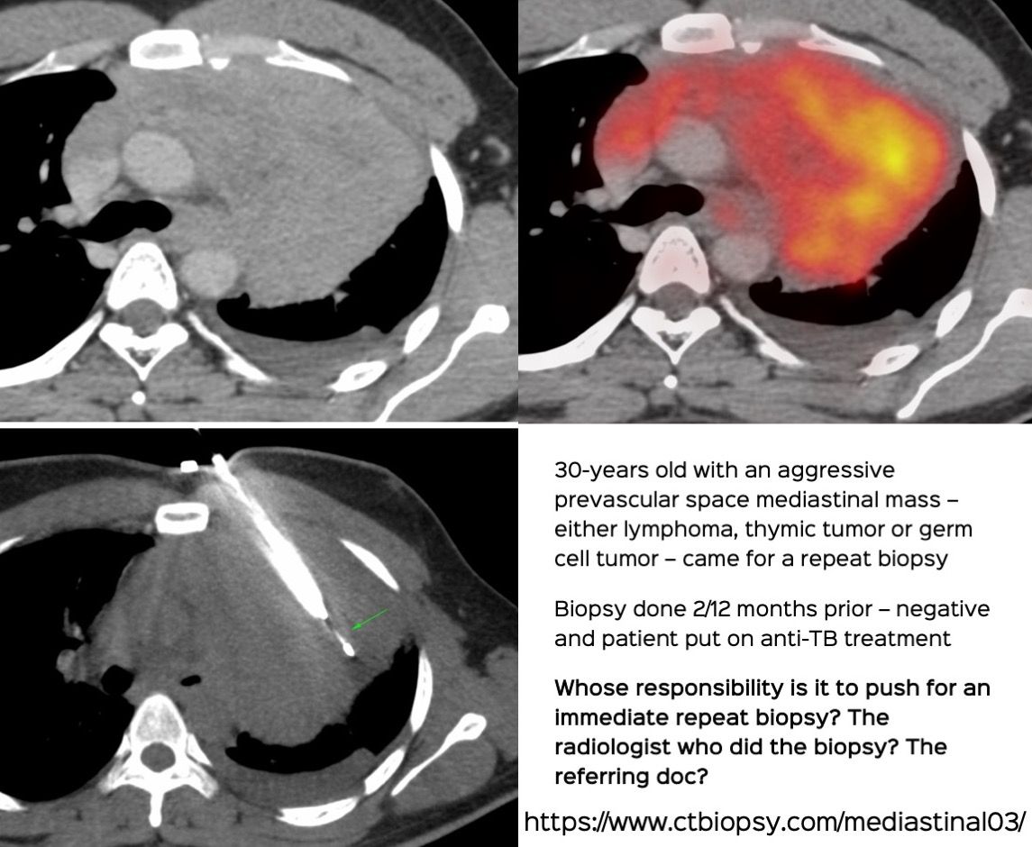Case 69: Whose Responsibility is It After a Negative Biopsy to Push for a Repeat Biopsy?