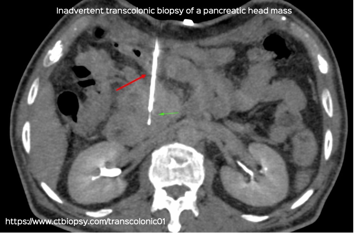 Case 79: Inadvertent Transcolonic Biopsy of a Pancreatic Head Mass