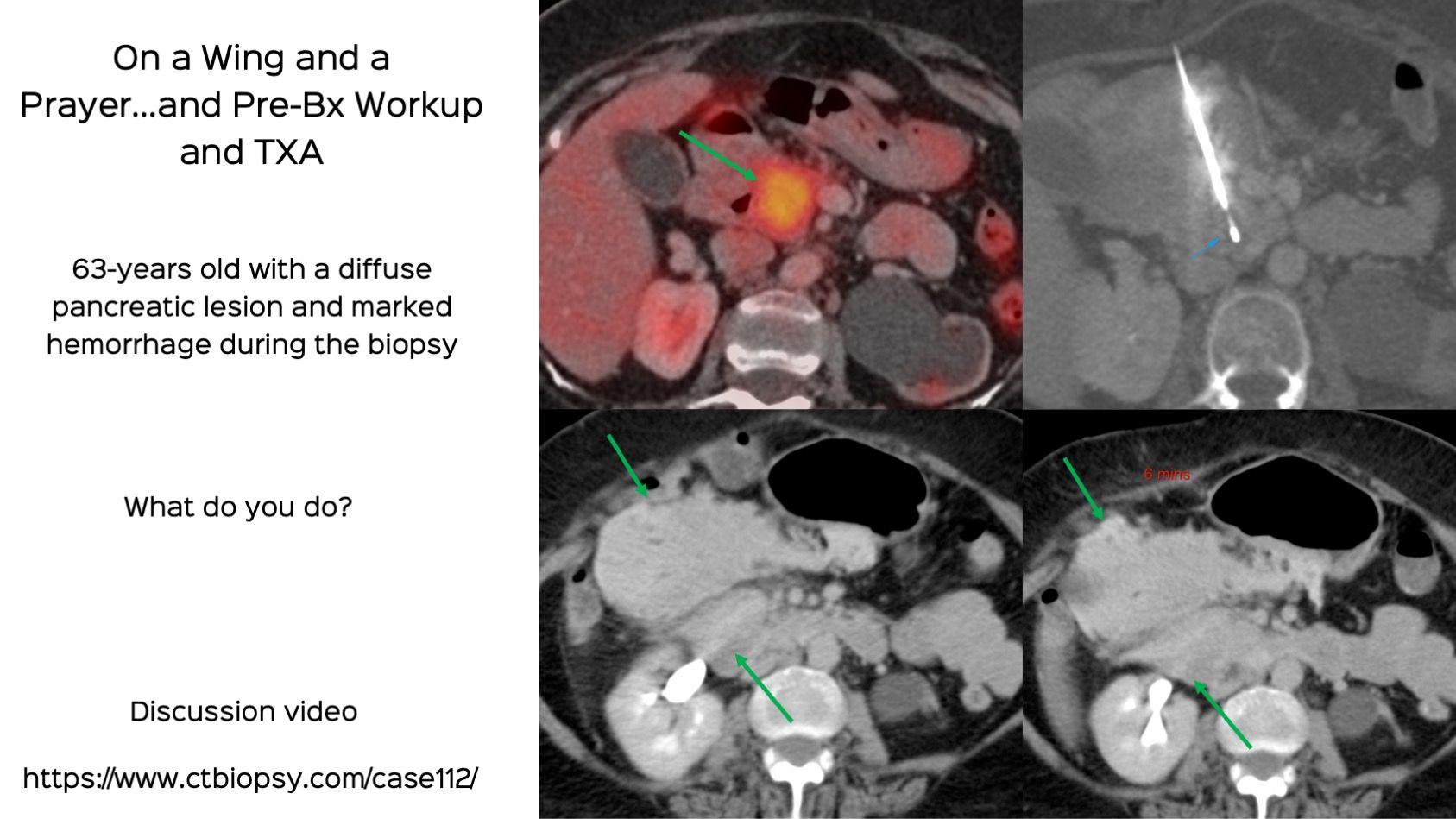 Case 112: Pancreatic Head Biopsy and Hemorrhage - On a Wing and a Prayer...And Pre-Bx Workup and TXA