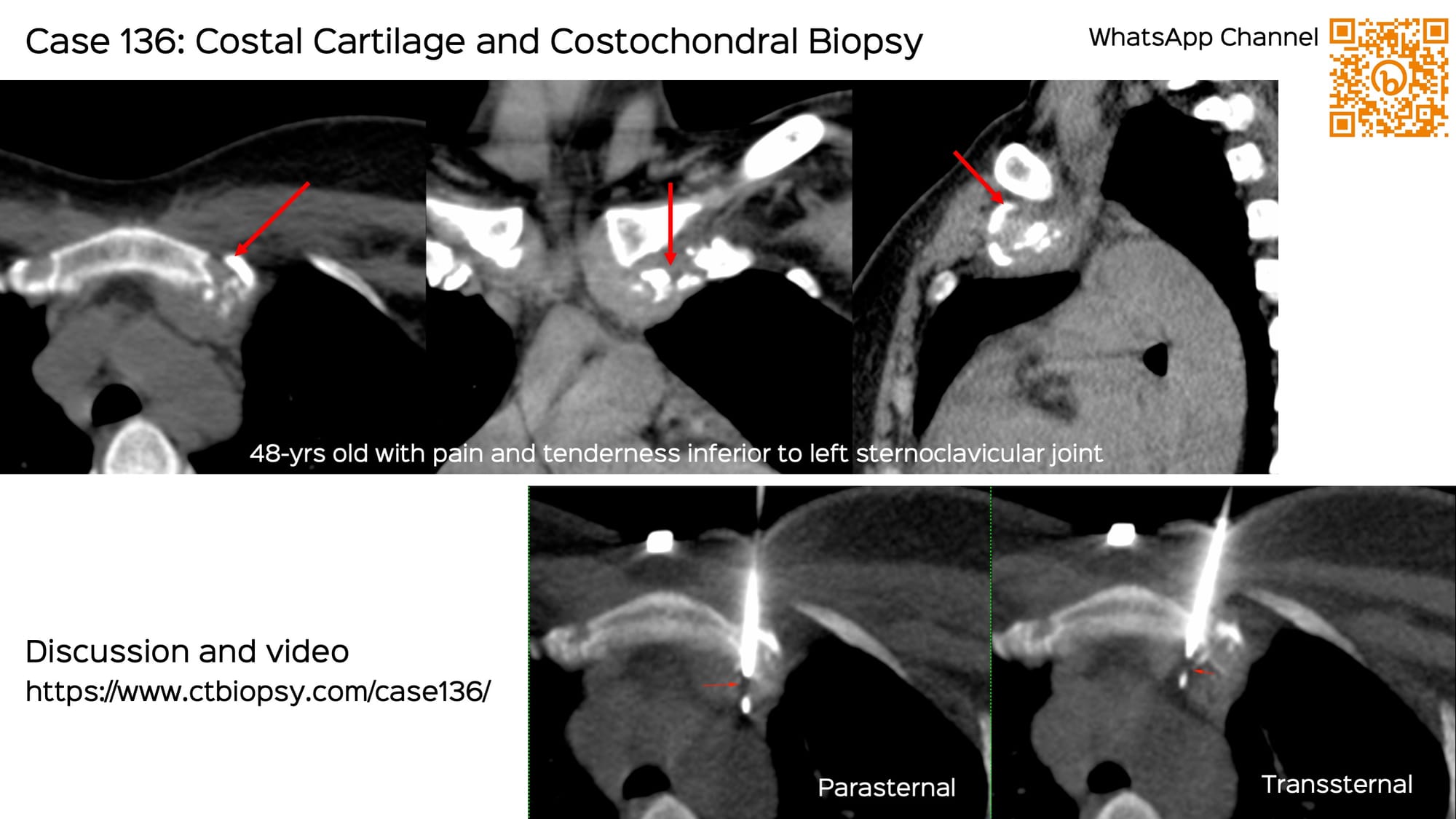 Case 136: Costal Cartilage and Costochondral Biopsy